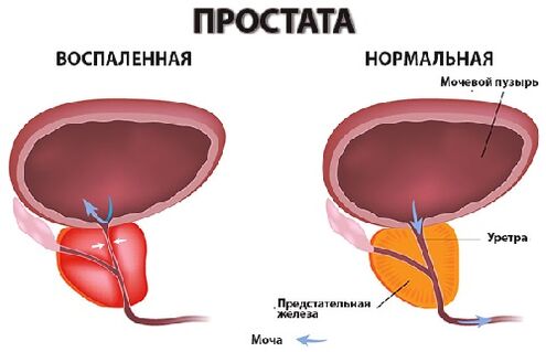 простата